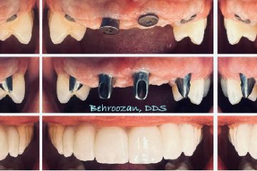 dental implant-01